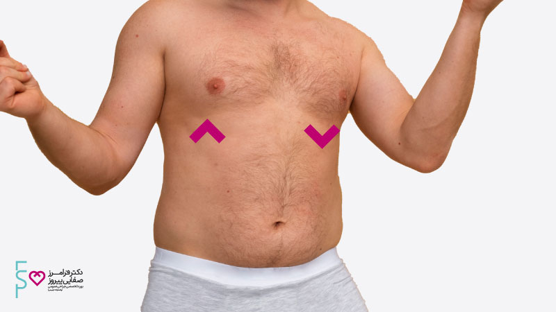 علل بزرگی سینه در آقایان | جراحی ژنیکوماستی