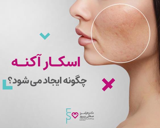 درمان اسکار آکنه(جای جوش)