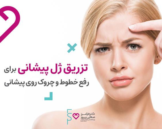 تزریق ژل پیشانی برای رفع خطوط و چروک روی پیشانی