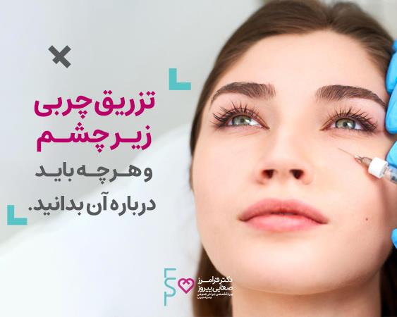 تزریق چربی زیر چشم و هرچه باید درباره آن بدانید