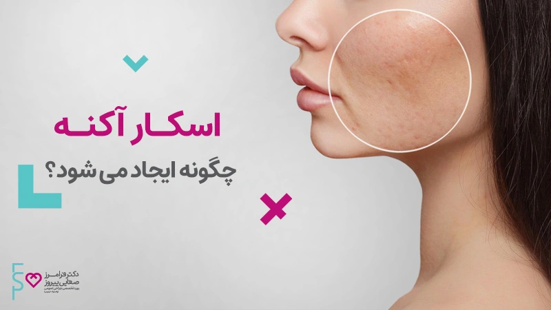 اسکار آکنه چگونه ایجاد می شود