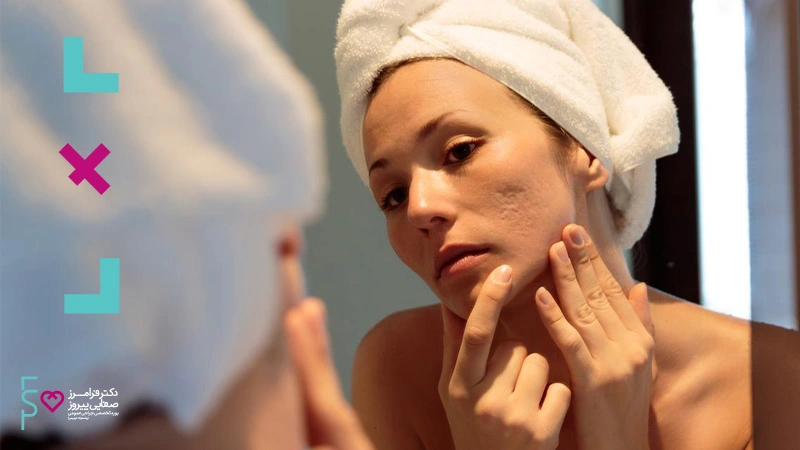 اسکار جای جوش