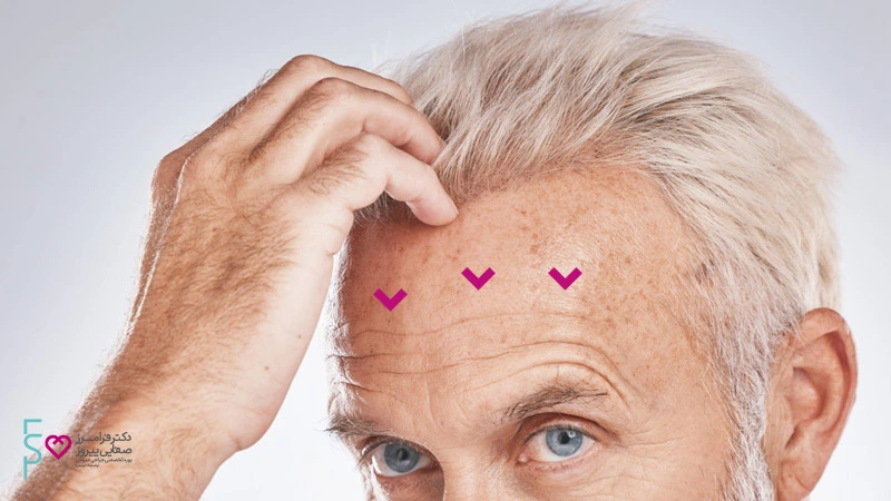 تزریق ژل پیشانی برای رفع خطوط و چروک روی پیشانی