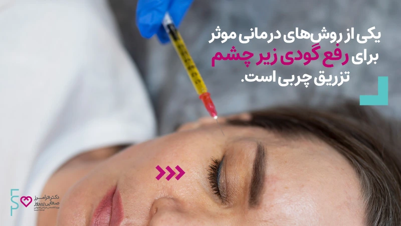 تزریق چربی زیر چشم و درمان گودی زیر چشم