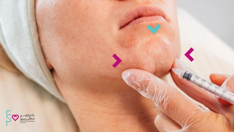 تزریق ژل و انواع آن