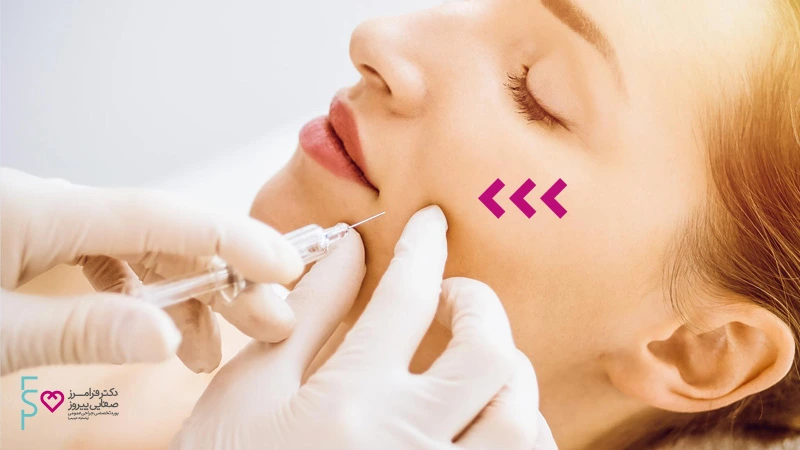 تزریق ژل گونه یا گونه‌گذاری با استفاده از ژل ژوویدرم