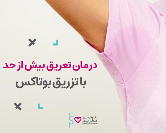 درمان تعریق بیش از حد با تزریق بوتاکس