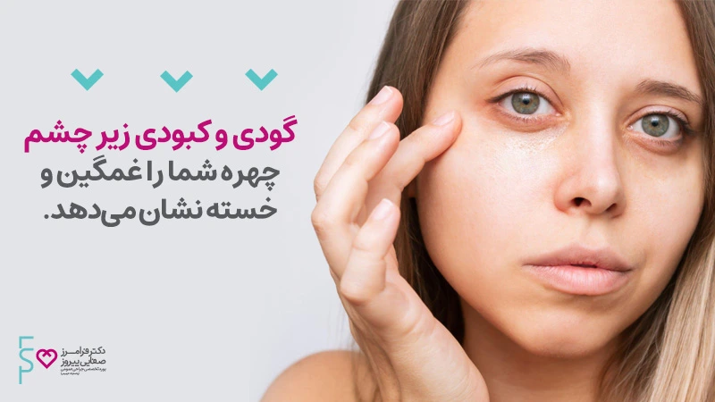 رفع گودی زیر چشم با تزریق چربی