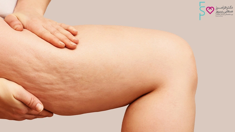 عمل لیپوساکشن ران