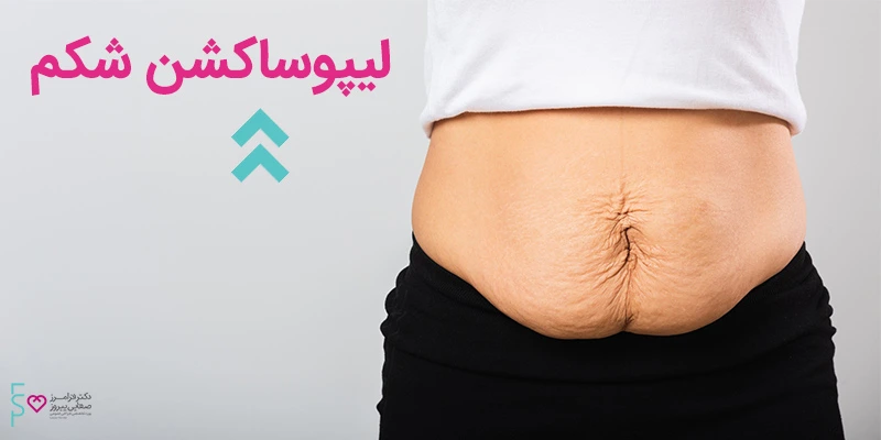 لیپوساکشن شکم جراحی زیبایی شکم