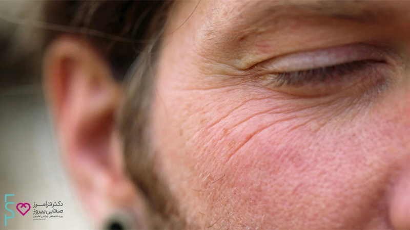 بوتاکس پنجه کلاغی برای از بین بردن خطوط دور چشم