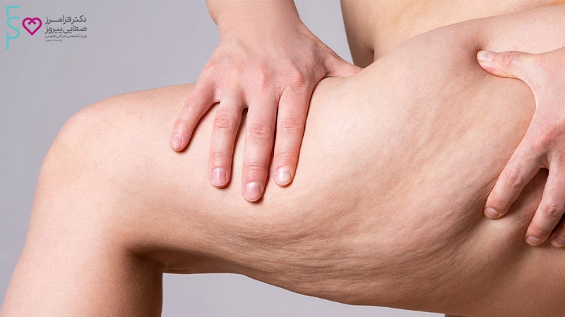 عمل لیپوساکشن ران