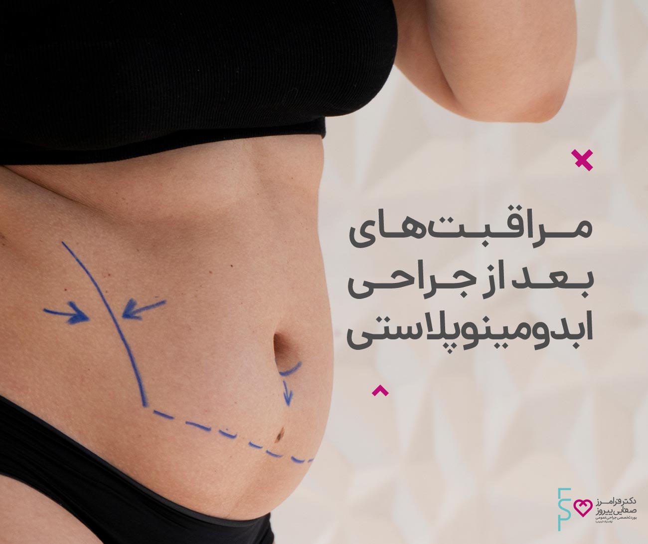 مراقبت بعد از آبدومینوپلاستی