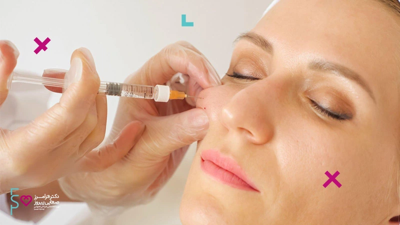 مزایای تزریق ژل فیلر