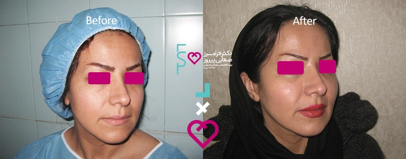 در مورد بوتاکس و بارداری چه می دانید؟ | عوارض بوتاکس در دوران بارداری و شیردهی