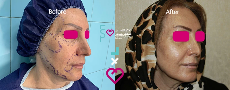 نمونه تزریق بوتاکس پیشانی دکتر صفایی رفع چین و چروک پیشانی