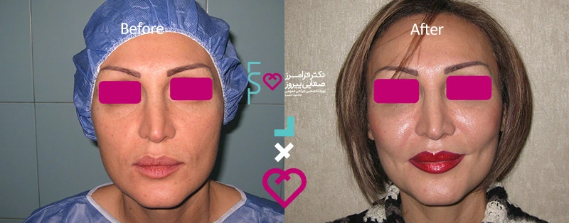 نمونه تزریق فیلر دکتر صفایی