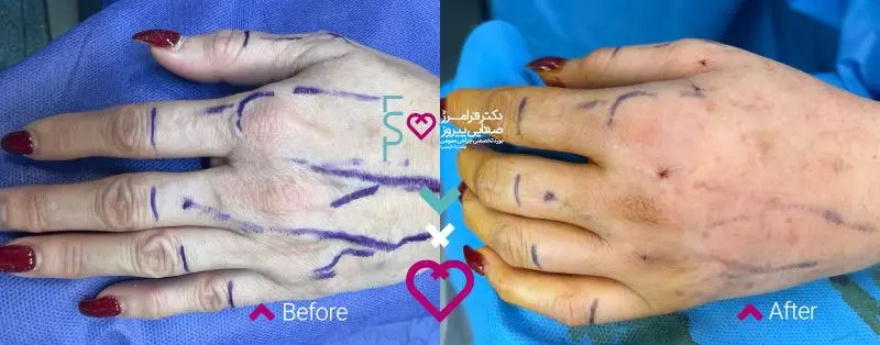 جوانسازی با تزریق چربی به دست