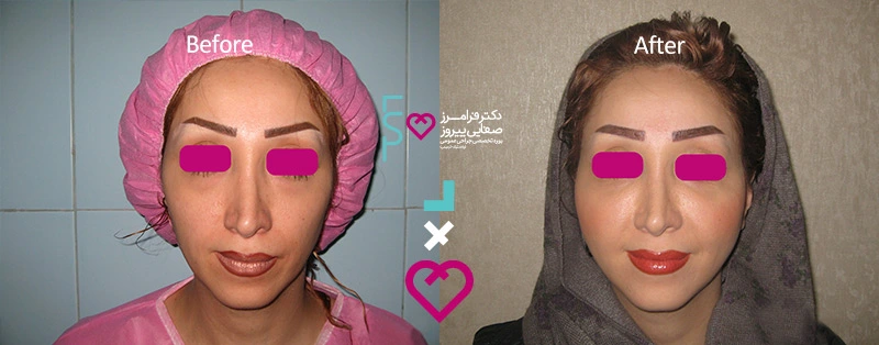 نمونه تزریق چربی به صورت دکتر فرامرز صفایی