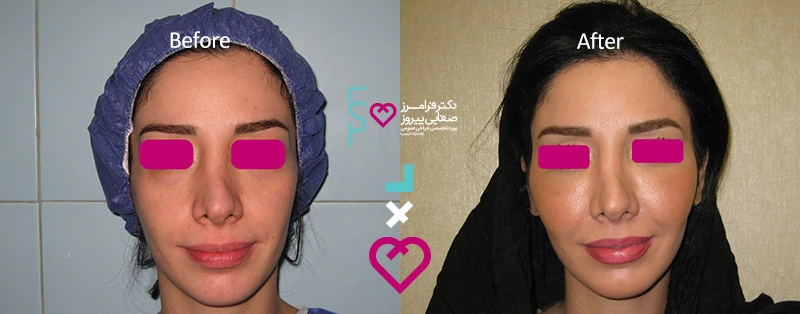 سوالات متداول تزریق چربی