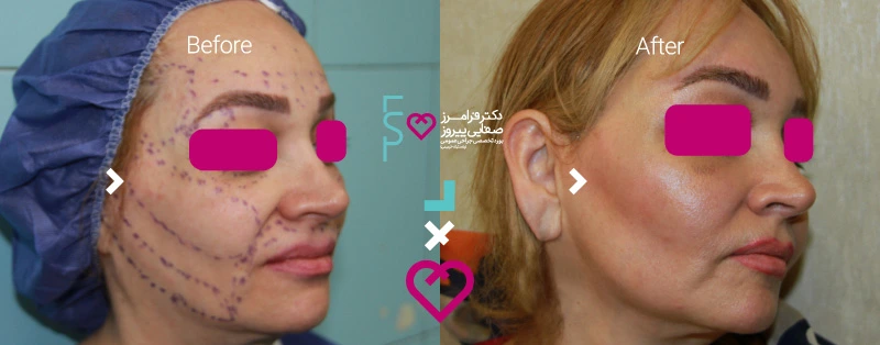 گونه گذاری با تزریق چربی