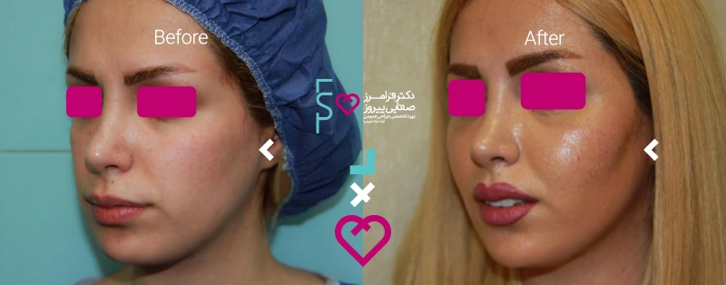 نمونه تزریق چربی به گونه دکتر فرامرز صفایی پیروز