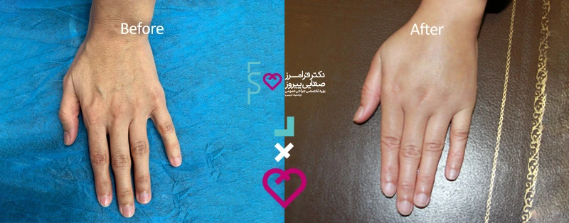 نمونه تزریق چربی دکتر صفایی