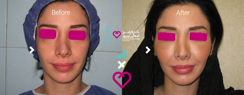 نمونه تزریق چربی صورت در افراد لاغر با دکتر صفایی