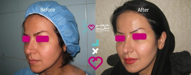 نمونه تزریق ژل به صورت دکتر فرامرز صفایی