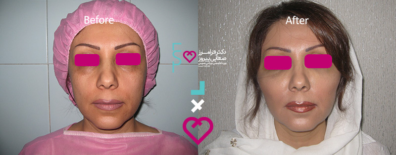 نمونه تزریق ژل پیشانی دکتر صفایی