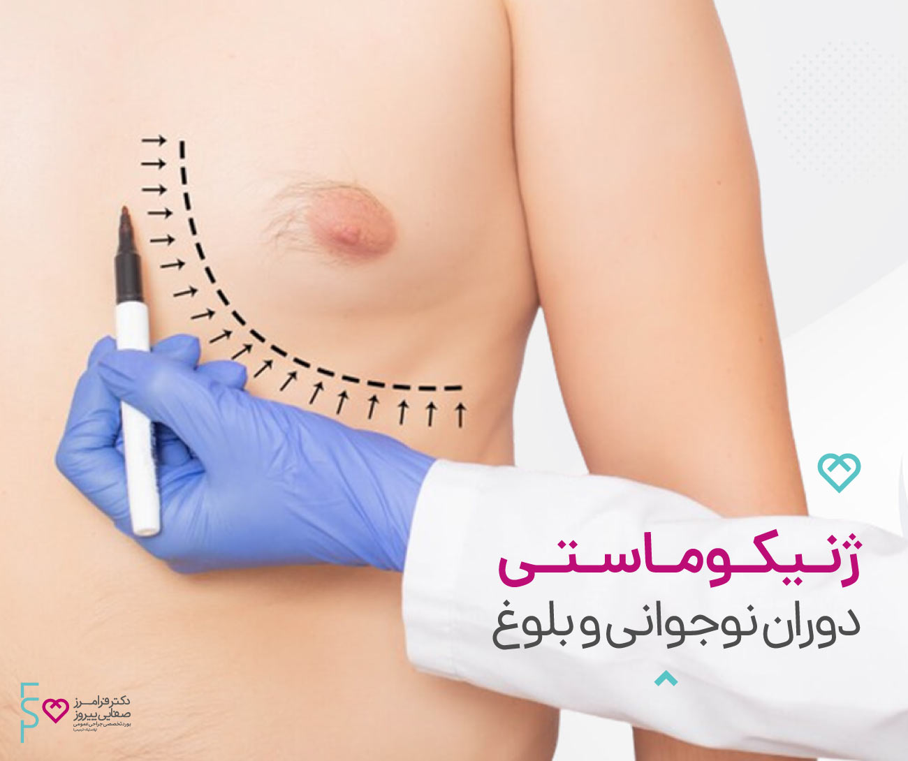 ژنیکوماستی در بلوغ