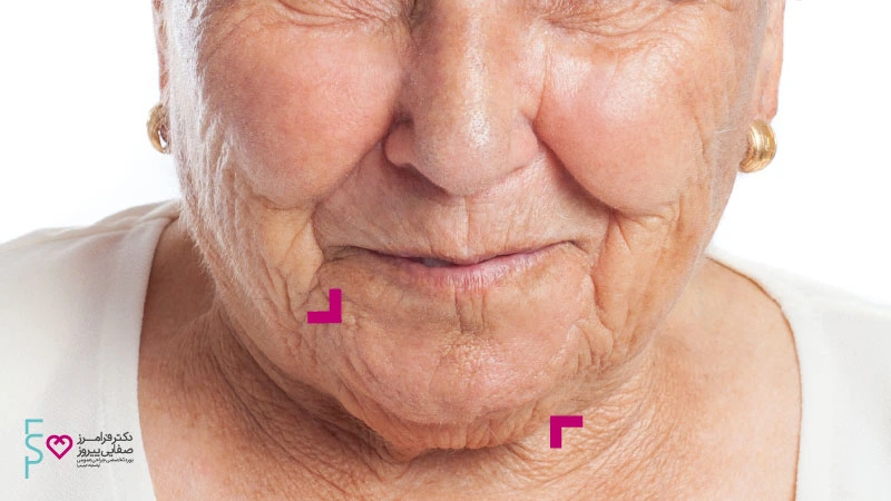 کاربرد تزریق بوتاکس چانه