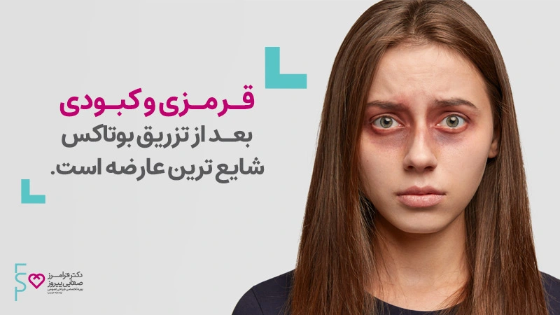 عوارض بوتاکس-کبودی محل تزریق بوتاکس