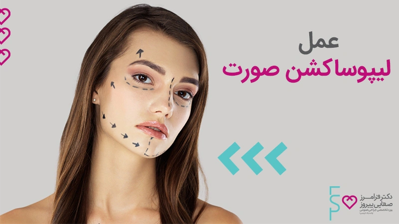 عمل لیپوساکشن صورت