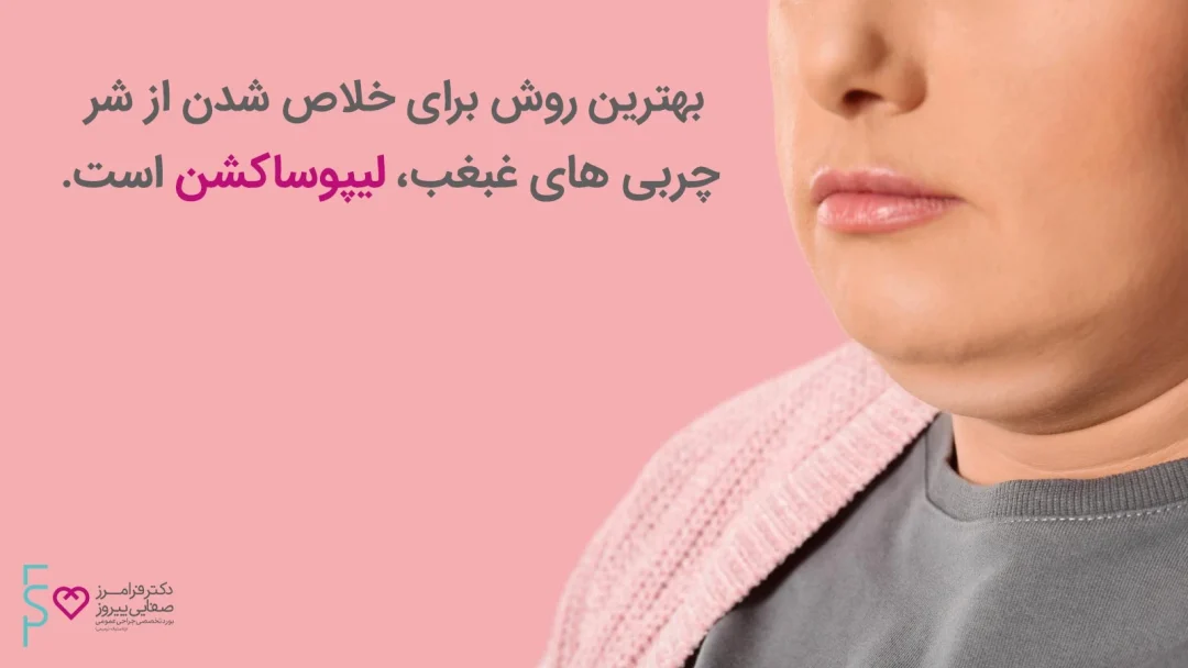 لیپوساکشن غبغب