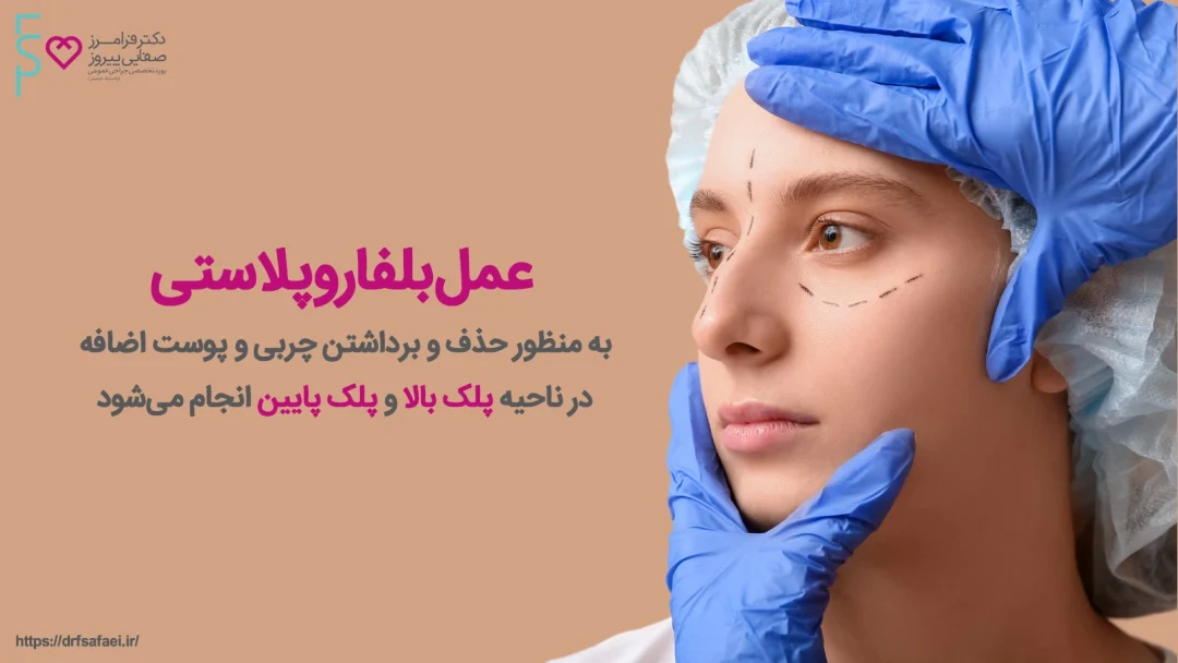 مراقبت های بلفاروپلاستی