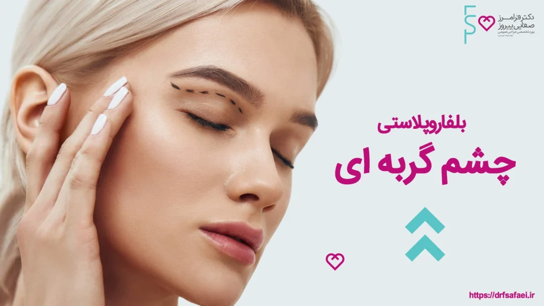 بلفاروپلاستی چشم گربه ای