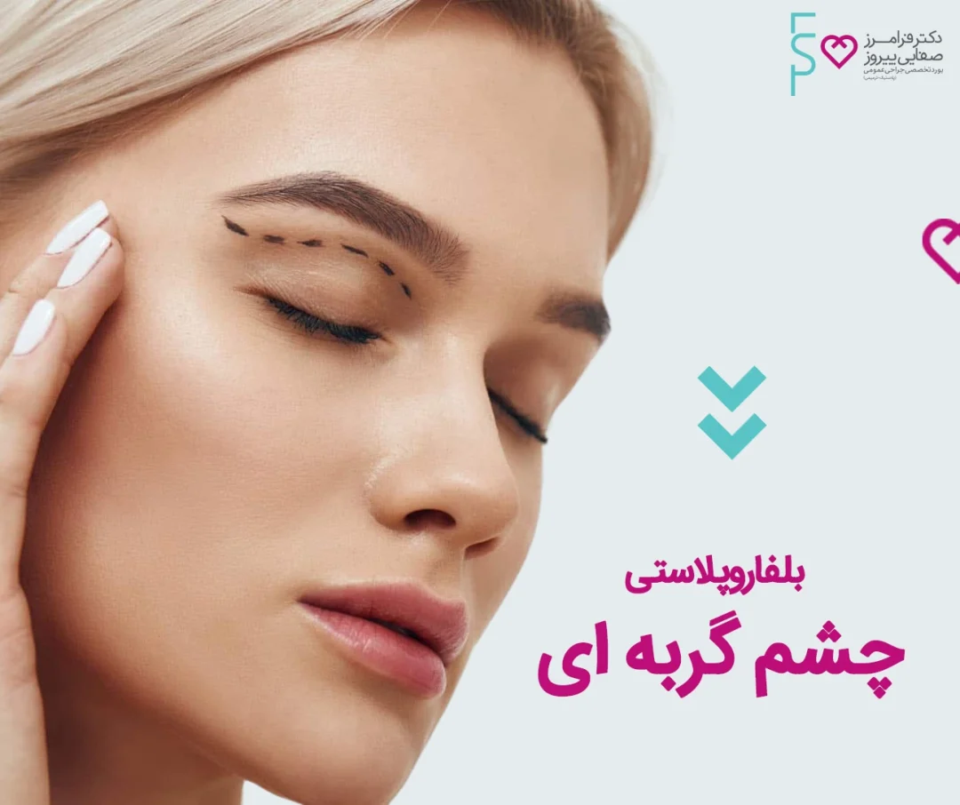 بلفاروپلاستی چشم گربه ای