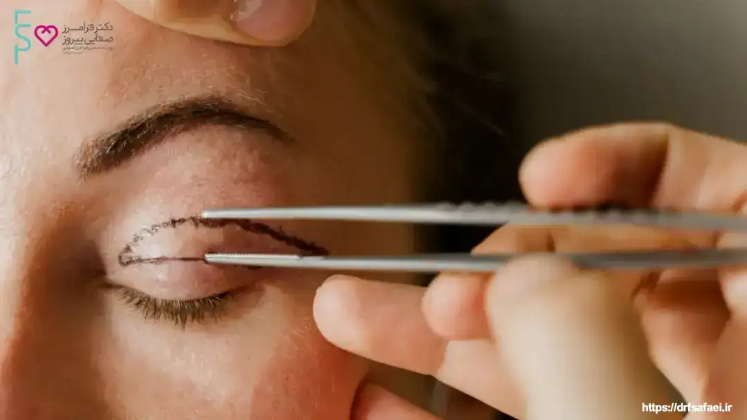 رضایت مراجع‌کننده از جراحی بلفاروپلاستی