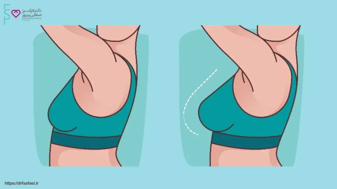 علت کاهش حجم سینه‌ها و کوچک بودن آن‌ها چیست؟