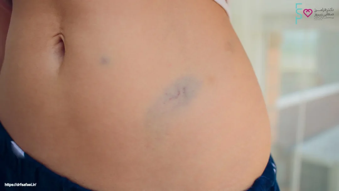 عوارض پیکر تراشی