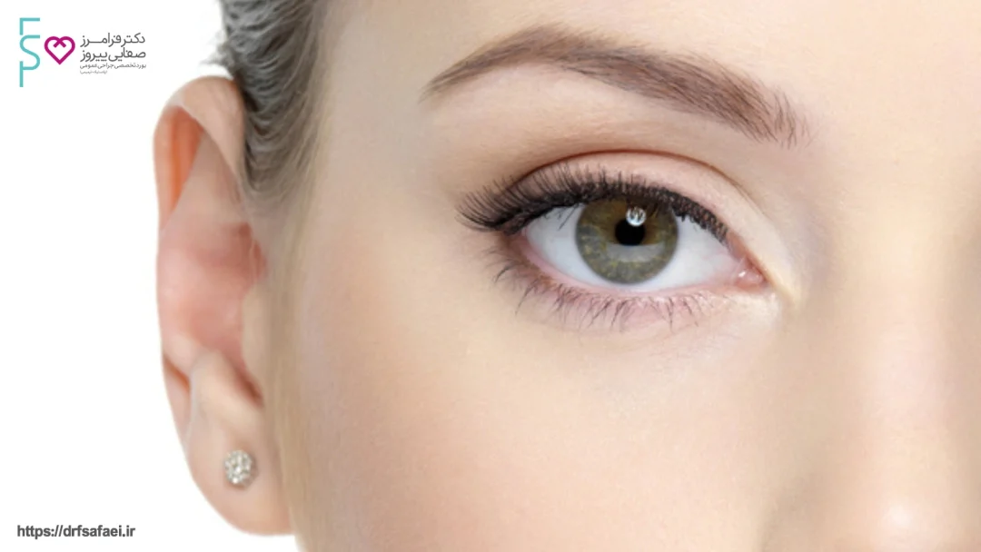 بلفاروپلاستی چشم گربه ای