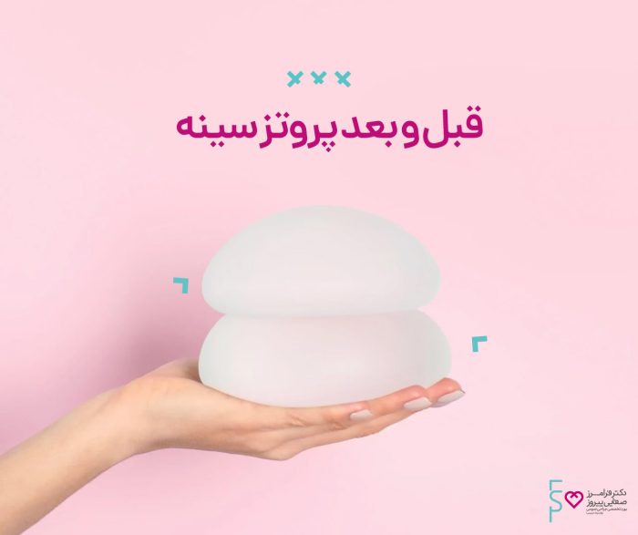 قبل و بعد پروتز سینه