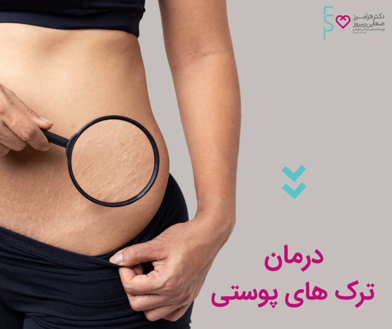 درمان ترک های پوستی