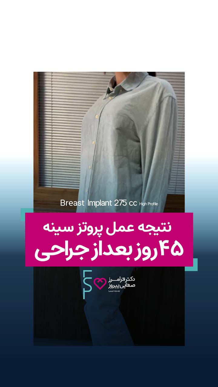 نتیجه پروتز سینه بعد از چهل و پنج روز