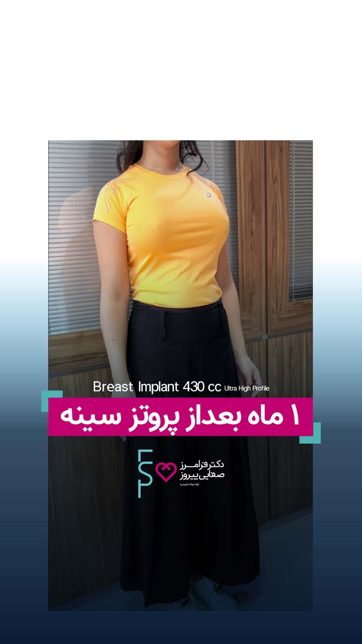 ۱ ماه بعد از پروتز سینه